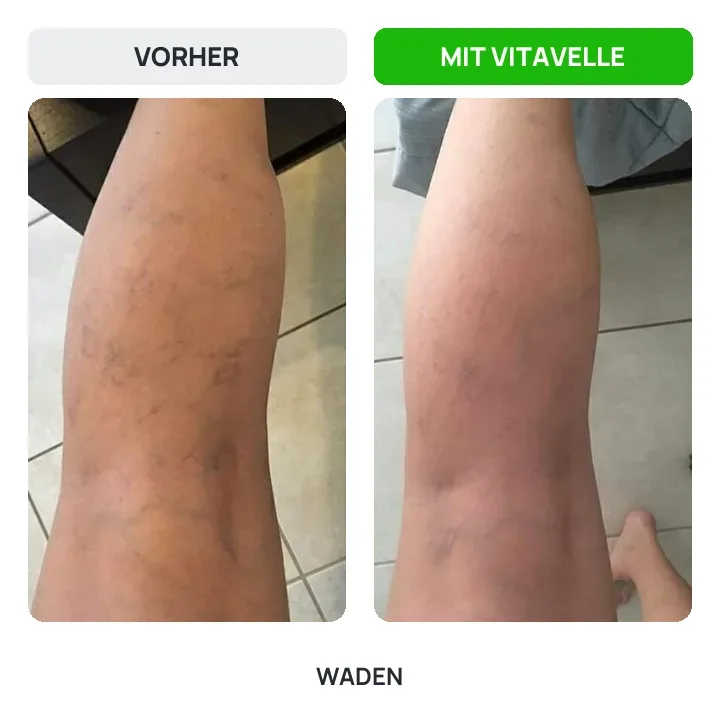 Vorher und nachher: Waden