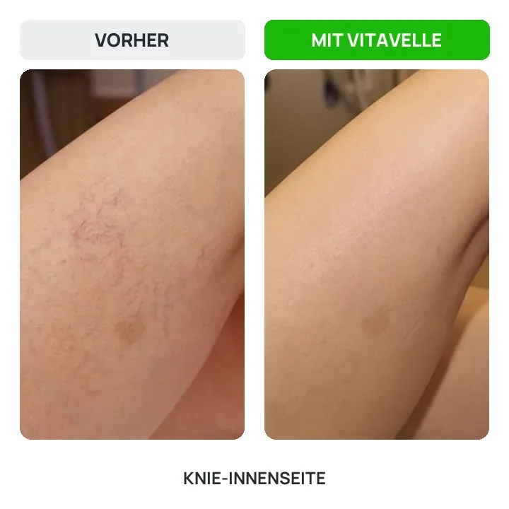 Vorher und nachher: Knie-Innenseite