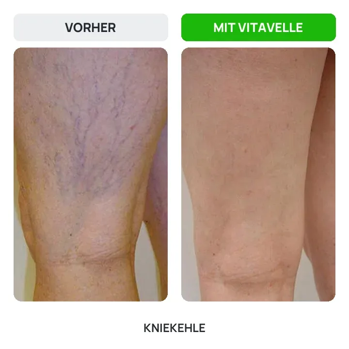 Vorher und nachher: Kniekehle