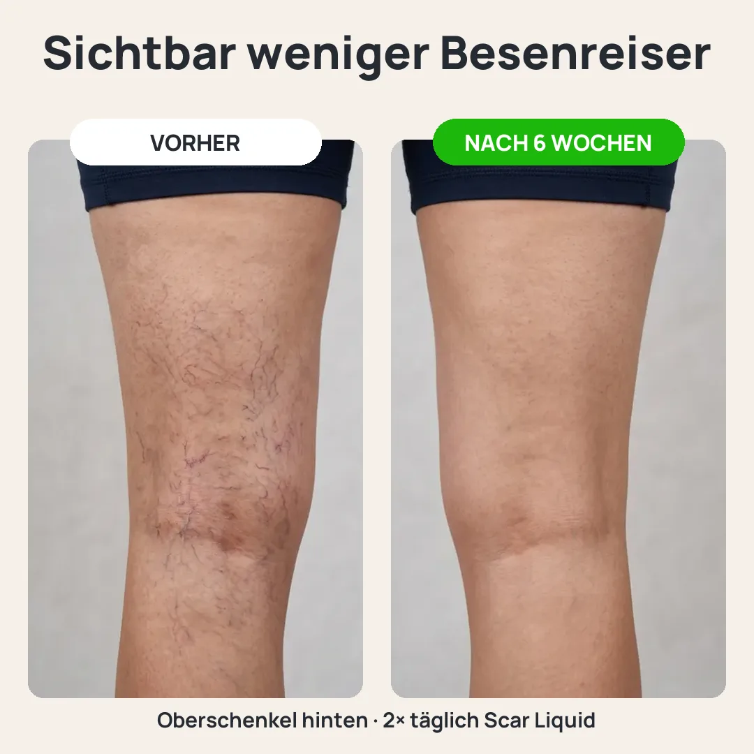 Oberschenkel vorher und nach 6 Wochen