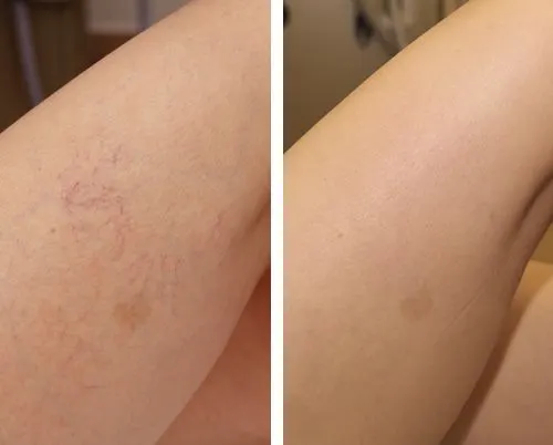Knie-Innenseite vorher und nachher